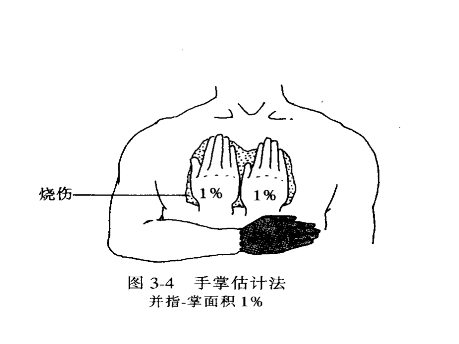 大面积烧伤的护理业务查房PPT课件.ppt_第3页