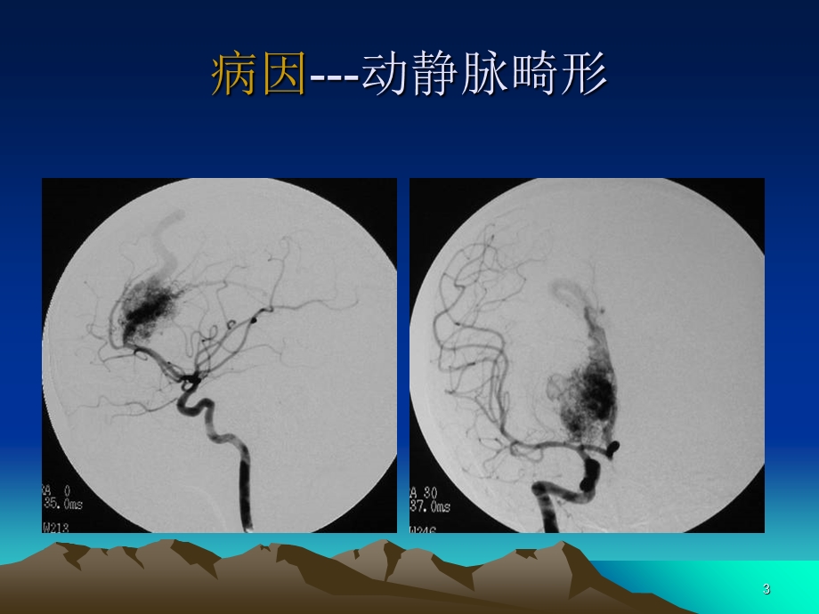 神经病学蛛网膜下腔出血PPT文档.ppt_第3页