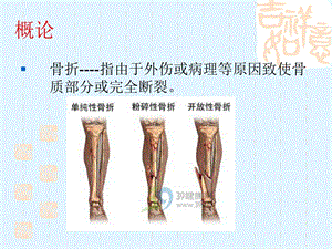 最新骨折后的康复PPT文档.ppt