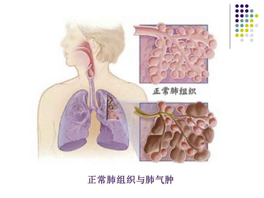 慢性阻塞性肺疾病1PPT文档资料.ppt_第2页