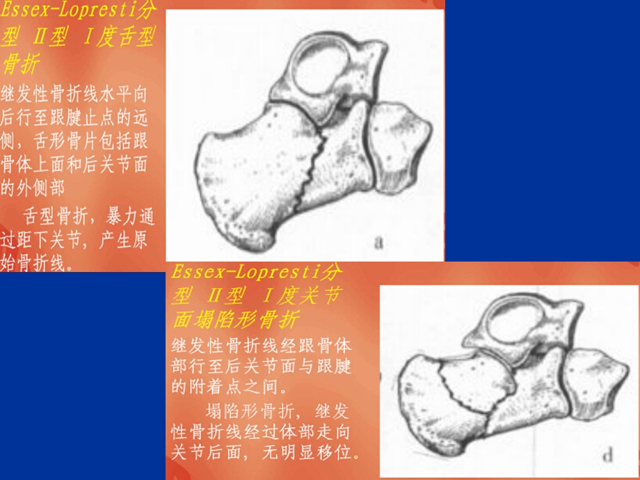 最新：跟骨折分型课件文档资料.ppt_第3页