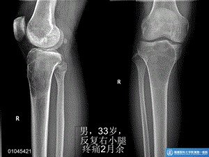 最新长骨良性纤维组织细胞瘤ppt课件PPT文档.ppt