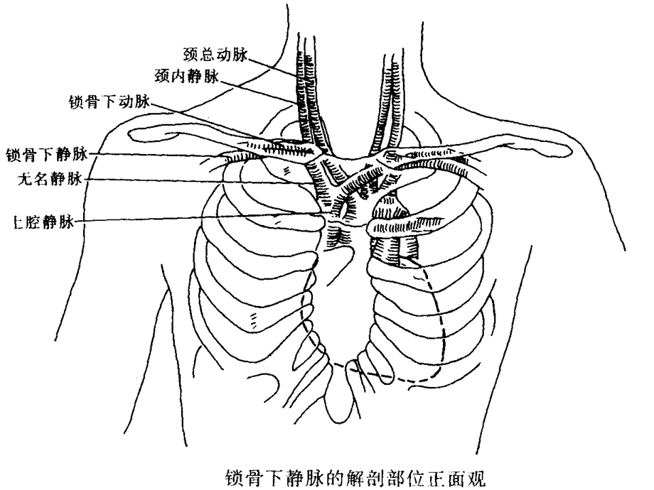 最新锁骨下静脉穿刺置管术PPT文档.ppt_第2页