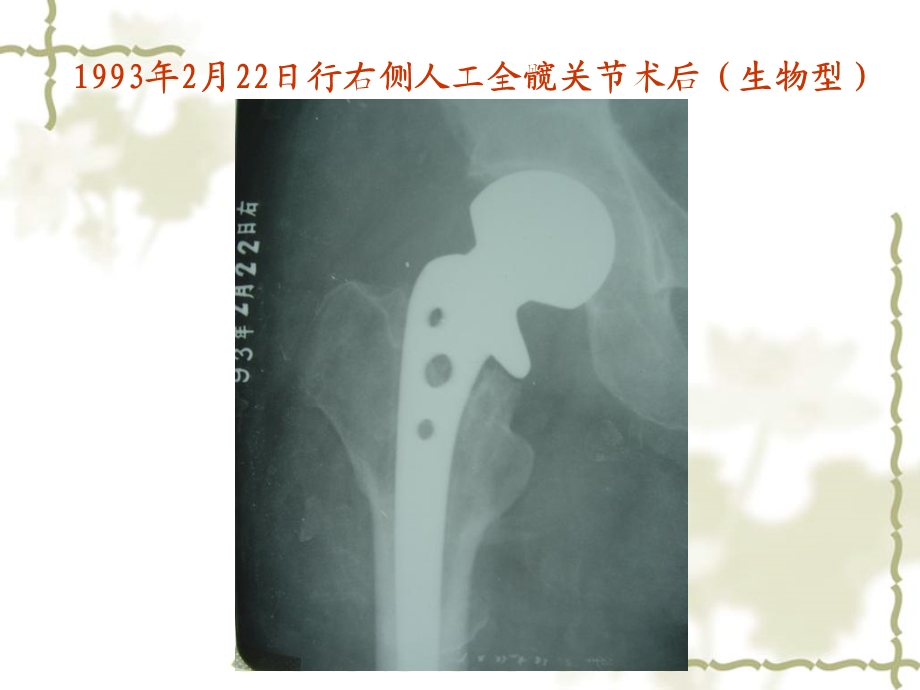 人工股骨头置换术后股骨柄假体断裂不伴临床症状病例一例精选文档.ppt_第3页