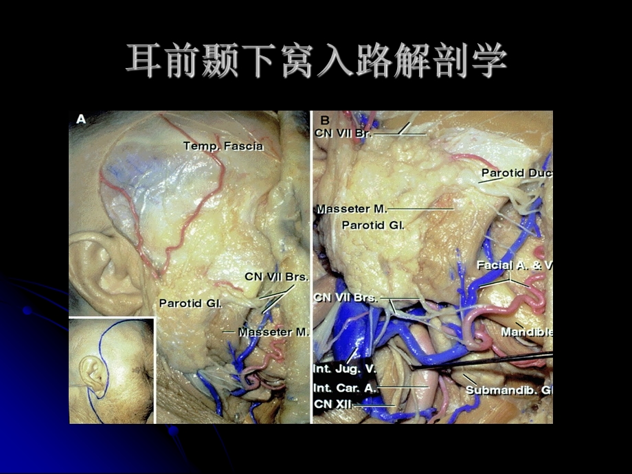 最新颞下窝手术入路PPT文档.ppt_第1页