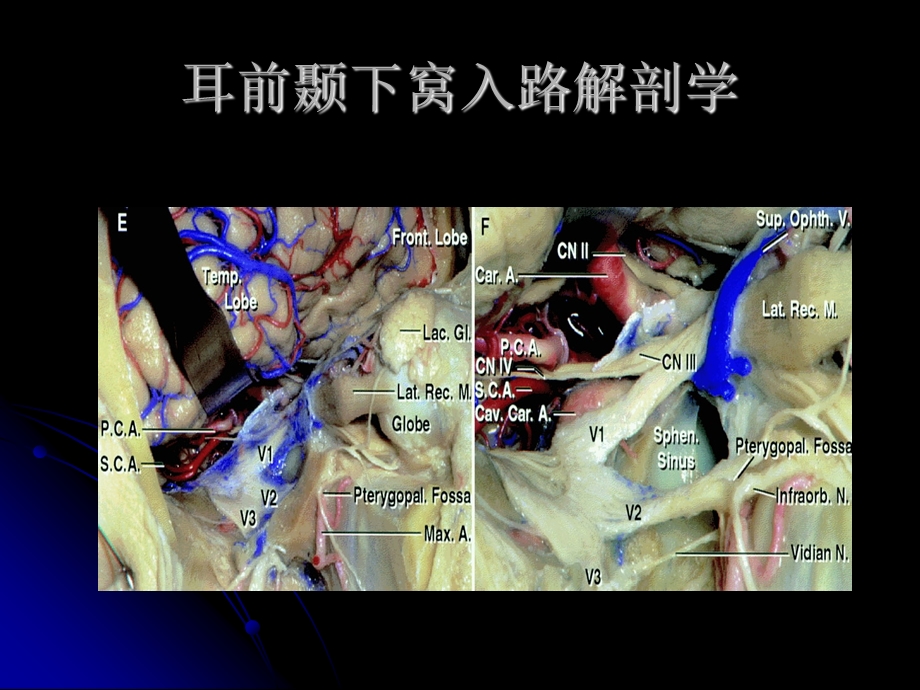 最新颞下窝手术入路PPT文档.ppt_第3页