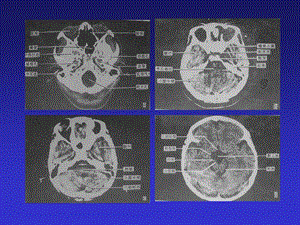 头颅胸部CTCT学习的资料课件文档资料.ppt