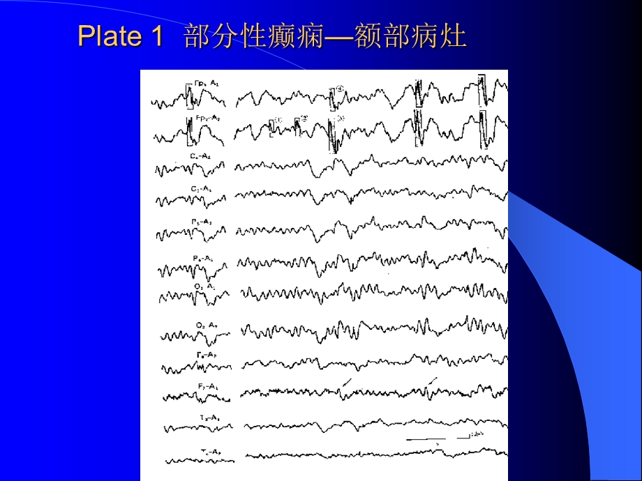 最新癫痫和脑电图2课件PPT文档.ppt_第2页