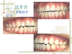 口腔正畸学第八章常见错合畸形的矫治二反合文档资料.ppt