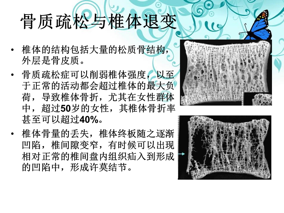 浅谈椎体成形术在骨质疏松性椎体压缩骨折中的应用精选文档.ppt_第3页