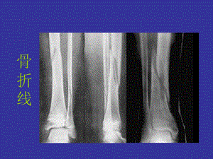 基本常识骨折PPT文档资料.ppt