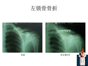 最新：骨折x线片汇总ppt课件文档资料.ppt