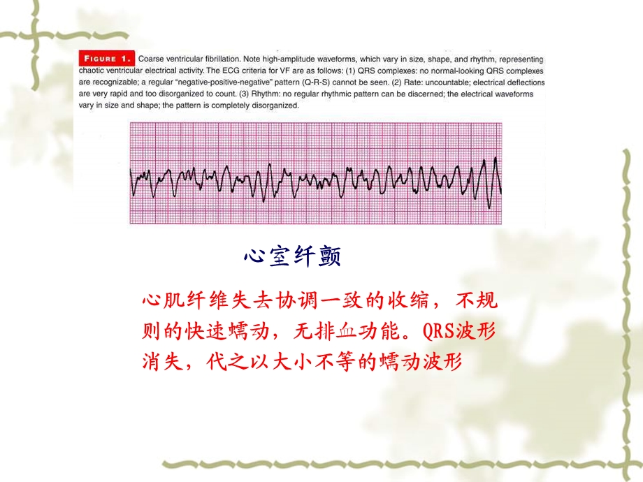 开胸心脏按压技术文档资料.ppt_第3页