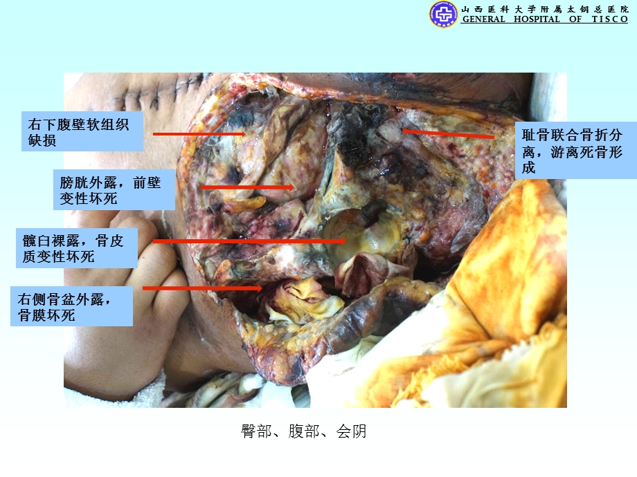 最新烧伤二科复杂病例323PPT文档.ppt_第3页