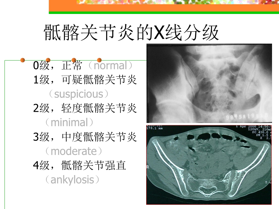 强直性脊柱炎早期诊断与处理进展文档资料.ppt_第3页