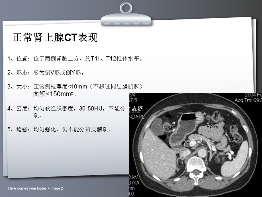 常见肾上腺肿瘤的ct诊断与鉴别诊断ppt课件精选文档.ppt_第2页