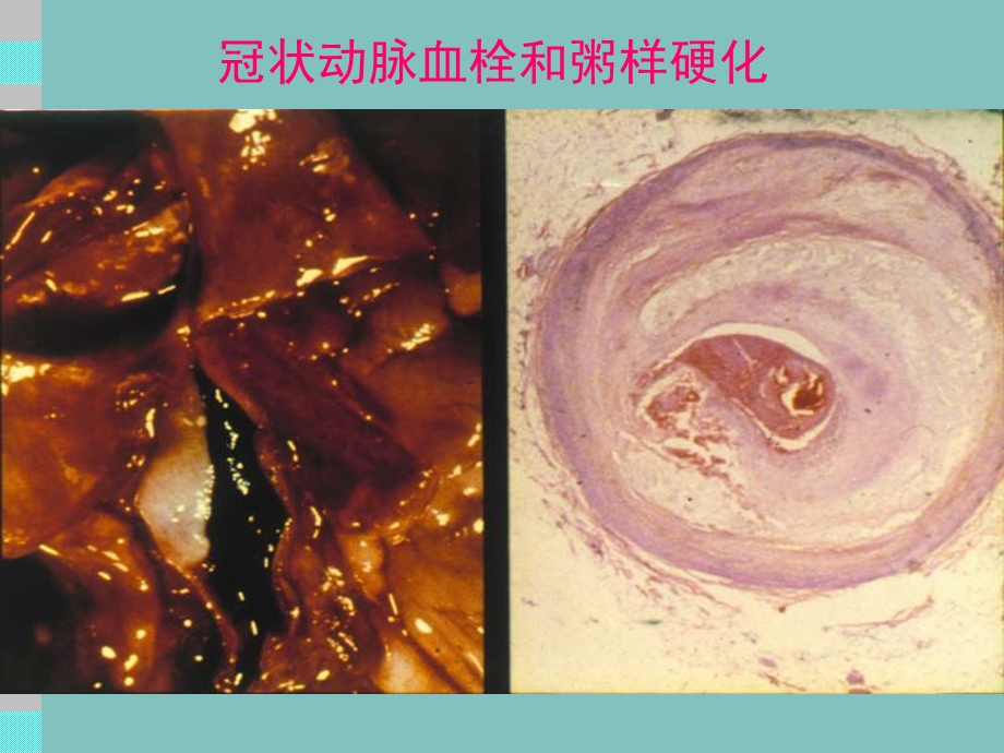 最新：【医药健康】冠状动脉粥样硬化性心脏病(CHD)文档资料.ppt_第2页