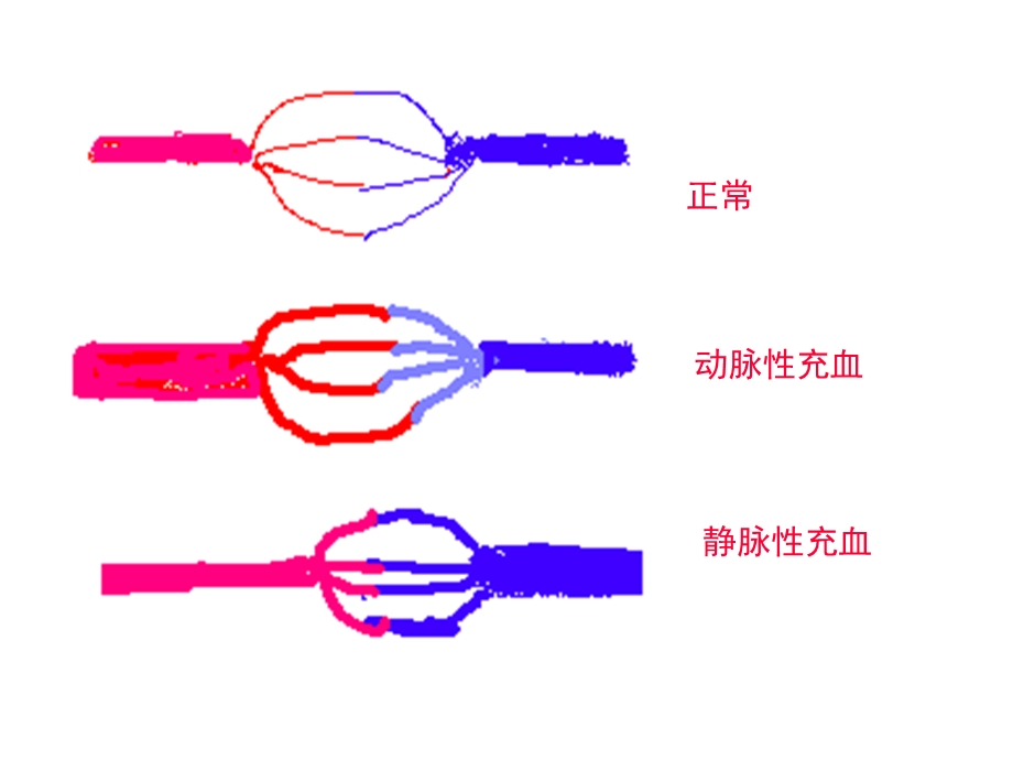 最新病理学第三章局部血液循环障碍PPT文档.ppt_第3页