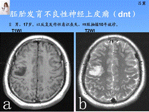 医影在线CNS疾病影像图库2PPT课件.ppt