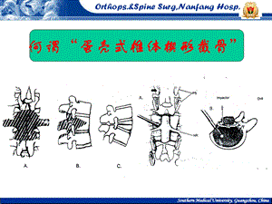 最新：蛋壳式椎体楔形截骨矫治脊柱后凸南方医科大学南方医院脊柱骨病外科王吉兴ppt课件文档资料.ppt