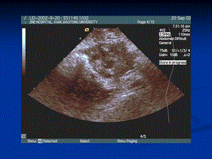 最新：滋养细胞疾病超声诊断文档资料.ppt