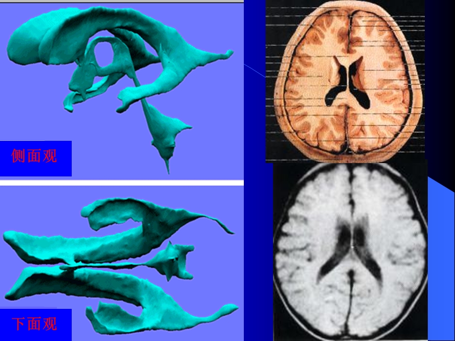 最新：脑池的断面解剖图文档资料.ppt_第3页