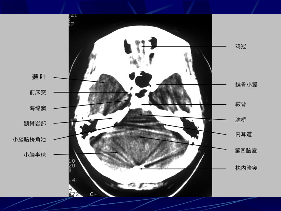最新中枢神经系统常见疾病CT表现PPT文档.ppt_第2页