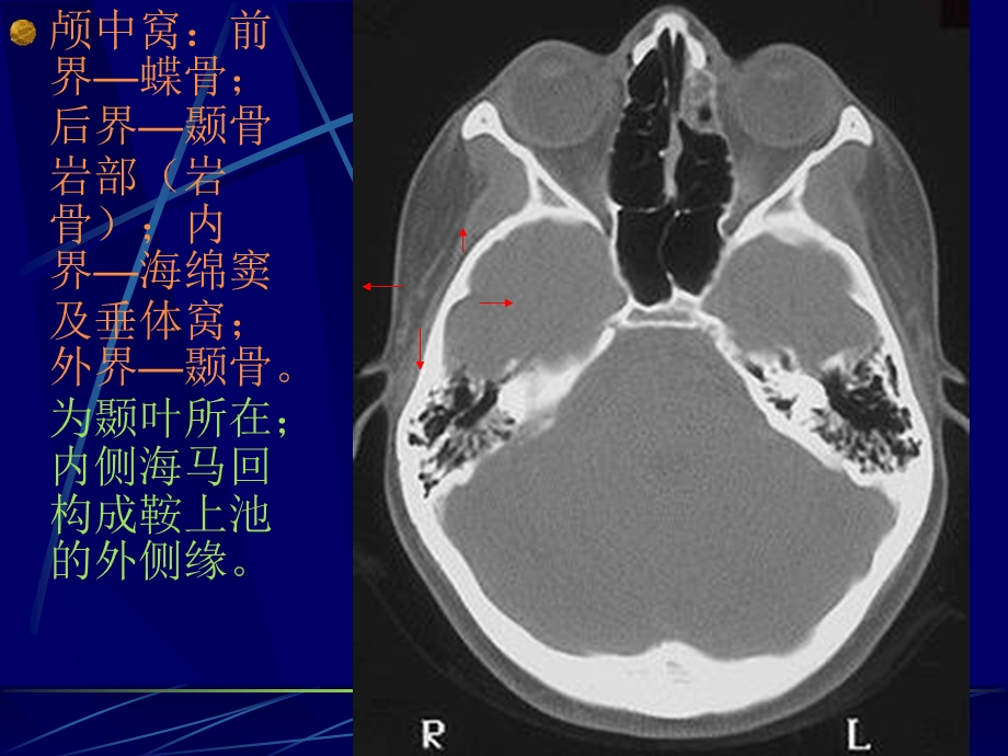 最新中枢神经系统常见疾病CT表现PPT文档.ppt_第3页