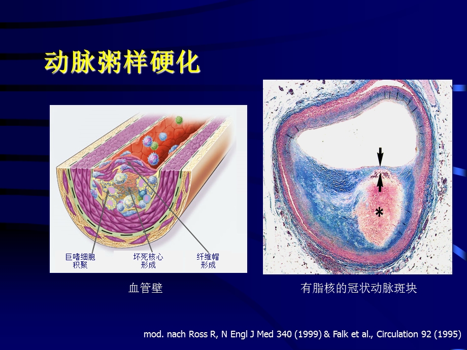 急性心肌梗死与冠脉介入治疗课件精选文档.ppt_第3页