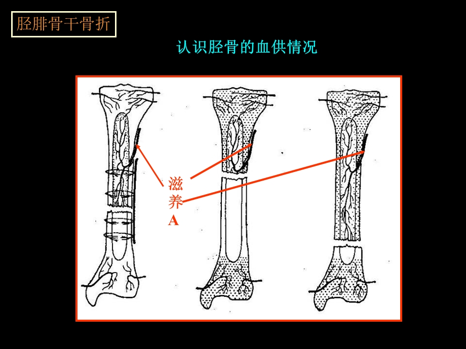 最新胫腓骨骨折手法整复PPT文档.ppt_第2页