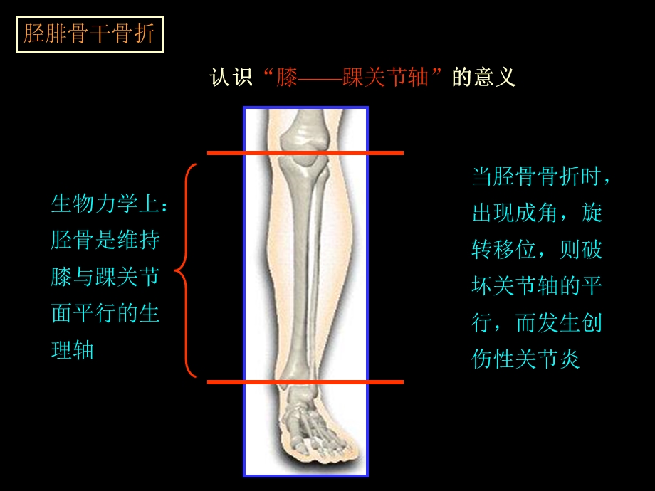 最新胫腓骨骨折手法整复PPT文档.ppt_第3页