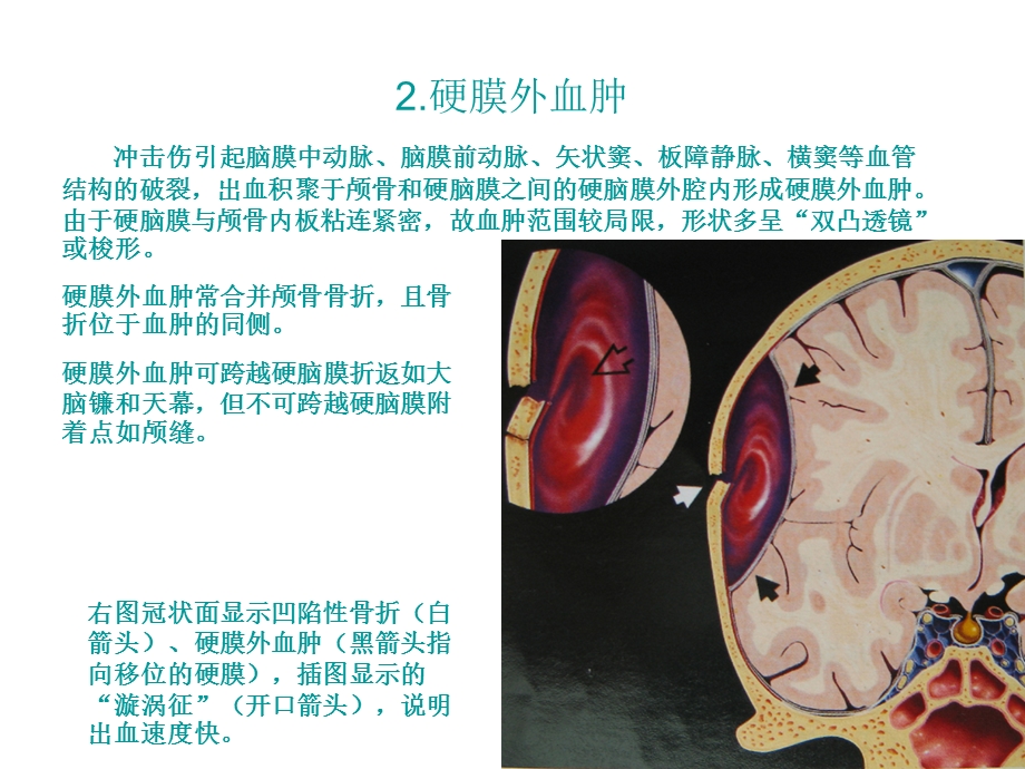 最新：颅脑外伤性疾病文档资料.ppt_第3页