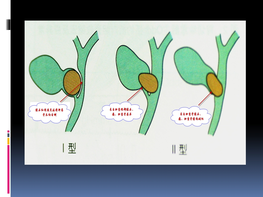 Mirizzi综合征的手术要点精选文档.pptx_第2页