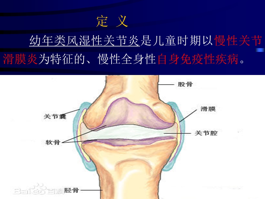 最新幼年类风湿性关节炎1ppt课件PPT文档.pptx_第3页