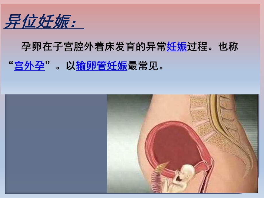 异位妊娠的术前与术后护理ppt课件PPT文档.pptx_第1页