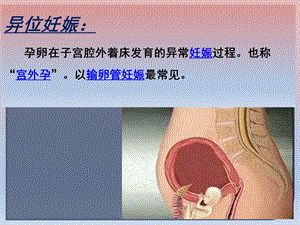 异位妊娠的术前与术后护理ppt课件PPT文档.pptx