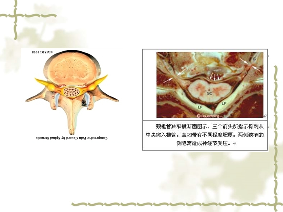 最新颈椎管狭窄症的诊断与治疗ppt课件PPT文档.ppt_第2页