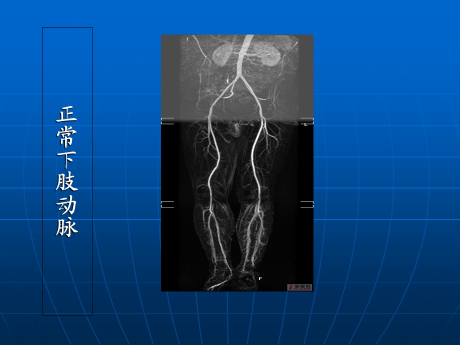 最新下肢动脉硬化闭塞症疾病概述PPT文档.ppt_第2页