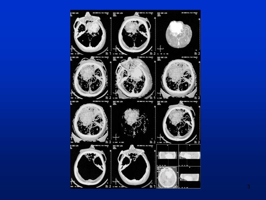 最新多层CT的临床应用PPT文档.ppt_第3页