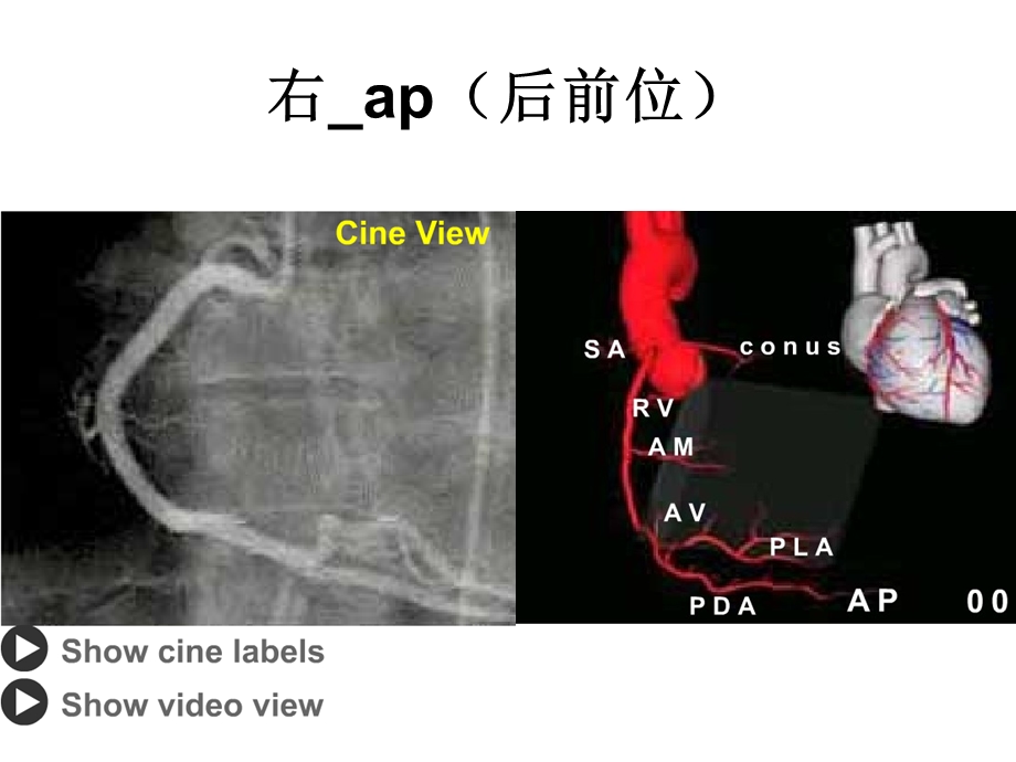 冠脉造影读片门新精选文档.ppt_第3页