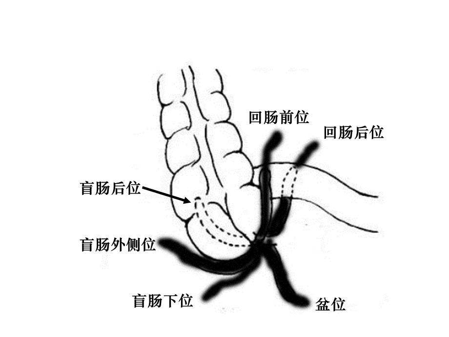 急性阑尾炎一点通PPT文档.ppt_第3页