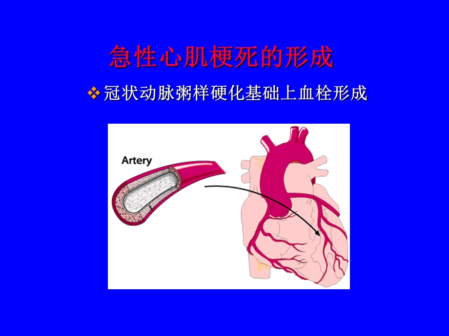 急性心肌梗死的心电图讲课PPT文档.ppt_第2页