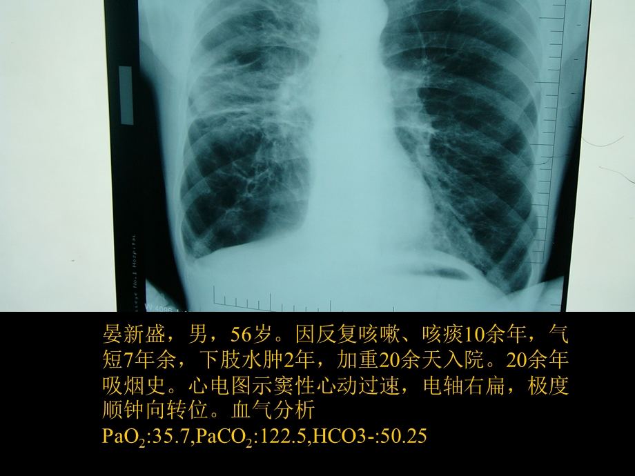 最新：慢性肺源心脏病文档资料.ppt_第1页