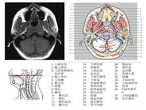 头颈CTMRI解剖图解第五季精选文档.ppt