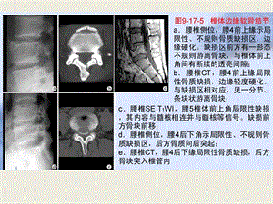 最新：南昌大学影像精品课程之骨骼疾病之二文档资料.ppt