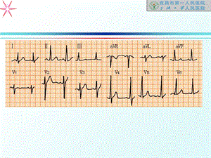 最新心电图讲义1PPT文档.ppt