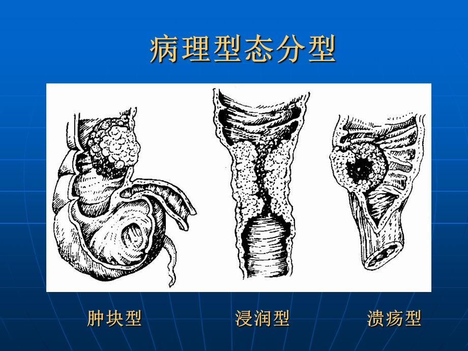 大肠癌病人的护理PPT文档资料.ppt_第3页