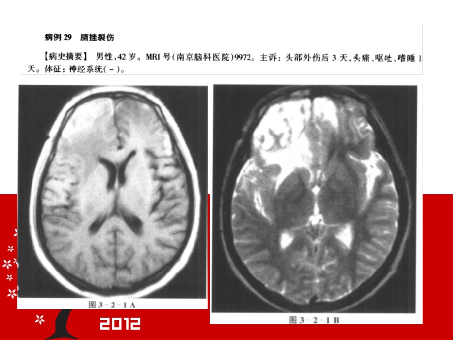 最新颅脑损伤的mri诊断1ppt课件PPT文档.ppt_第1页