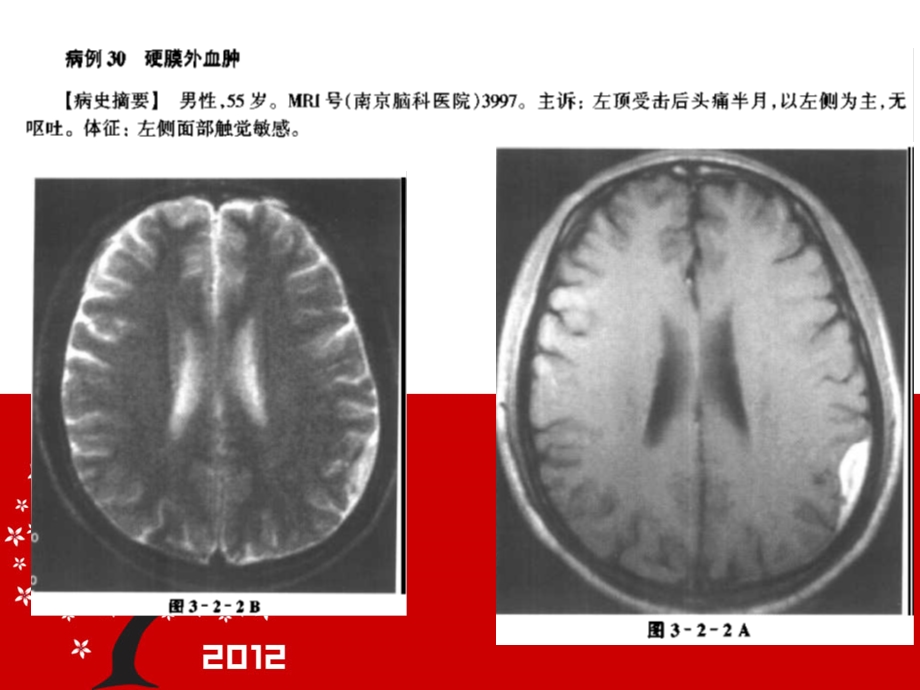 最新颅脑损伤的mri诊断1ppt课件PPT文档.ppt_第3页