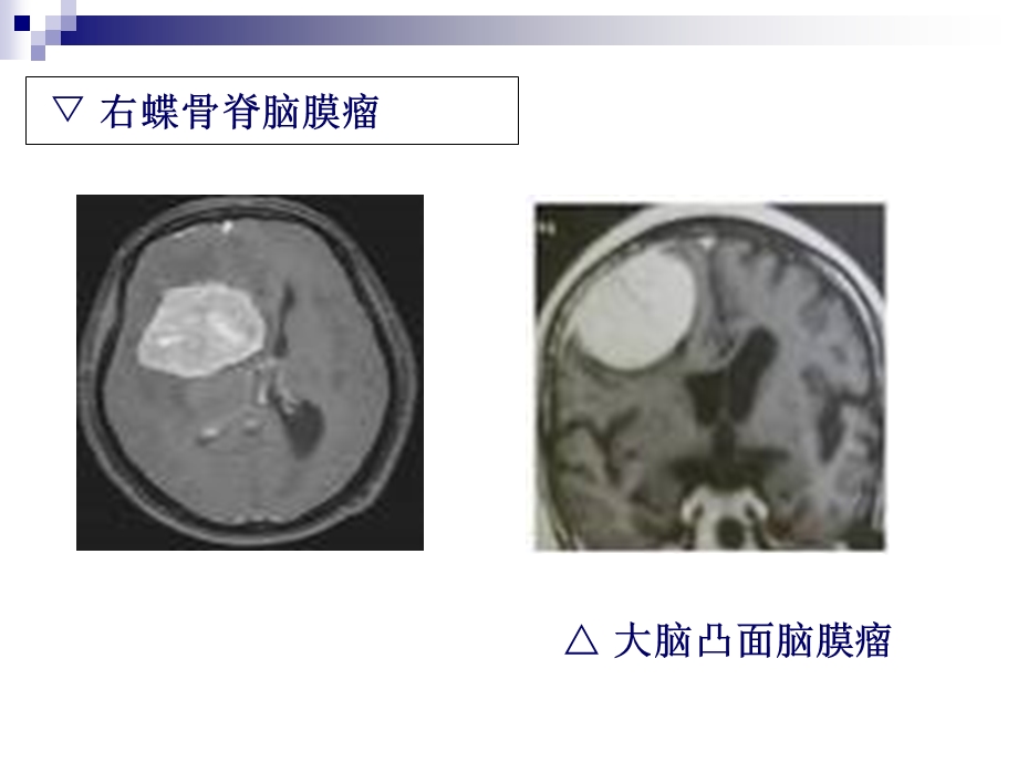 最新脑膜瘤件课件PPT文档.ppt_第3页